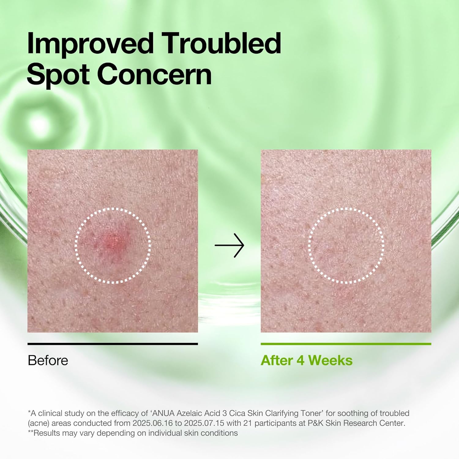 ANUA Azelaic Acid 3 + CICA toner for blemish-prone skin