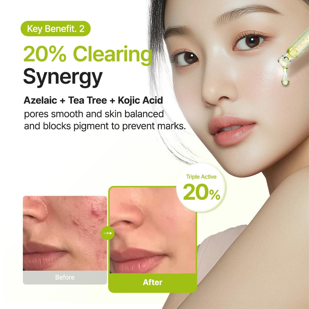 Korean azelaic acid serum for oily and acne-prone skin