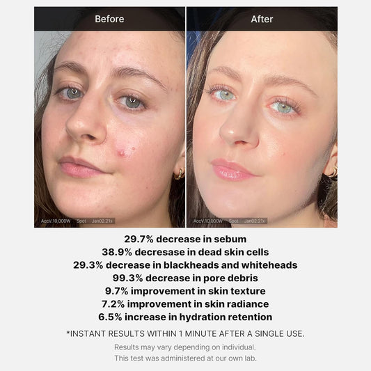 MEDICUBE Red Acne Succinic Acid Peel Serum - Glam Secret